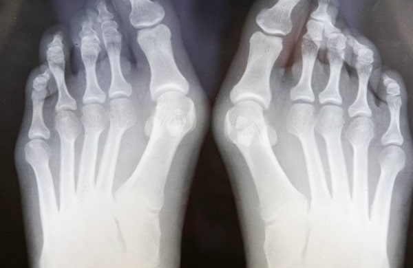 Prevent Hallux Valgus